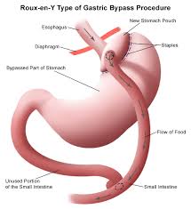 Gastric Bypass Procedure