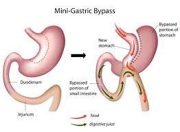 Mini Gastric Bypass