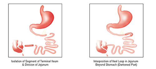 Illeal Transplantation