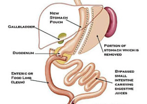 laparoscopic-sleeve-gastrec